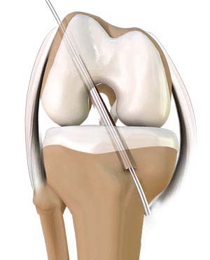 ACL Reconstruction - Anterior Cruciate Ligament Tears